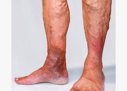 Variz interna pierna